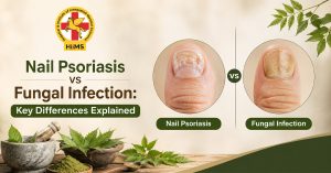 Nail Psoriasis vs Fungal Infection