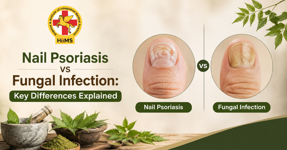 Nail Psoriasis vs Fungal Infection