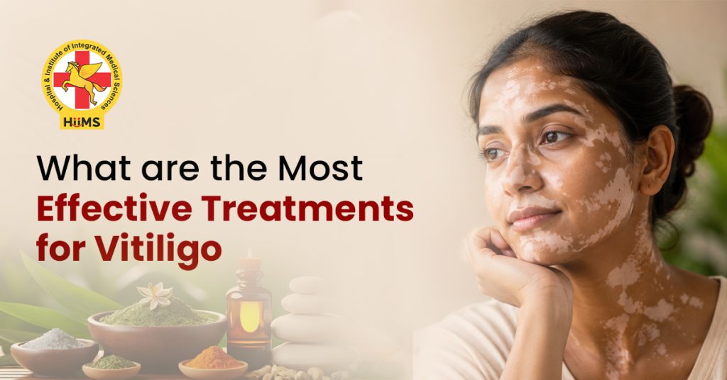 Vitiligo