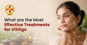 Vitiligo
