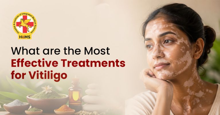 Vitiligo