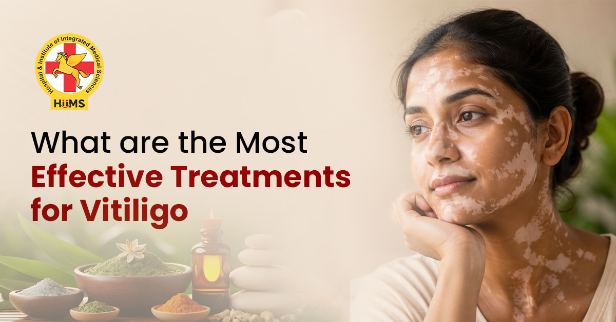 Vitiligo