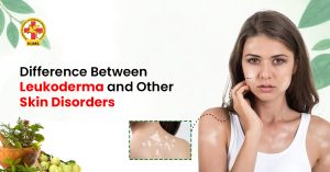 Difference Between Leukoderma and Other Skin Disorders