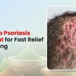 Best Scalp Psoriasis Treatment for Fast Relief from Itching