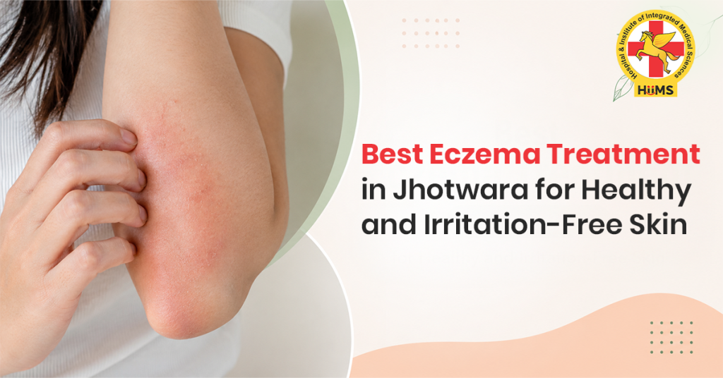 Best Eczema Treatment in Jhotwara