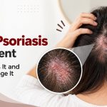 Scalp Psoriasis Treatment: What Causes It and How to Manage It
