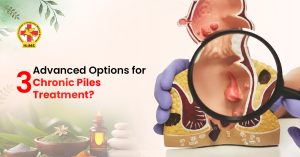 3 Advanced Options for Chronic Piles Treatment
