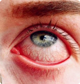 Eye Disease