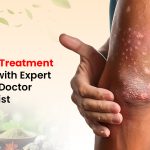 Psoriasis Treatment Hospital