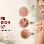 What Are Fungal Skin Diseases? Types, Signs and Prevention