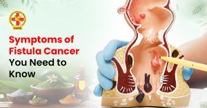 fistula cancer symptoms