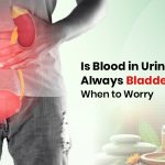 Is Blood in Urine Always Bladder Cancer? When to Worry