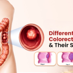 Understanding the Different Stages of Colorectal Cancer and Their Symptoms