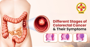 Understanding the Different Stages of Colorectal Cancer and Their Symptoms (2)