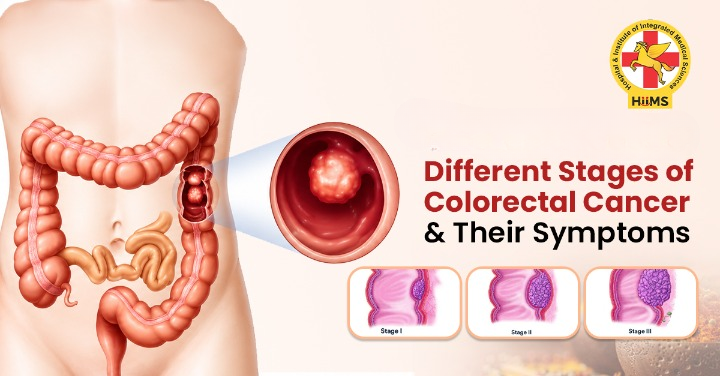 Understanding the Different Stages of Colorectal Cancer and Their Symptoms (2)