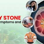 kidney stones treatment