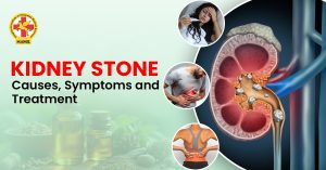 kidney stones treatment