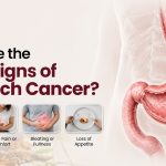 What Are the Early Signs of Stomach Cancer?
