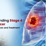 Understanding Stage 4 Lung Cancer: Causes, Diagnosis, and Treatment