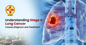 Stage-4-Lung-Cancer