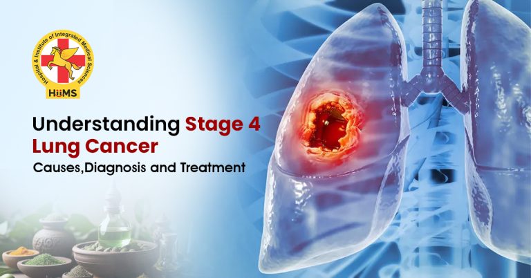 Stage-4-Lung-Cancer