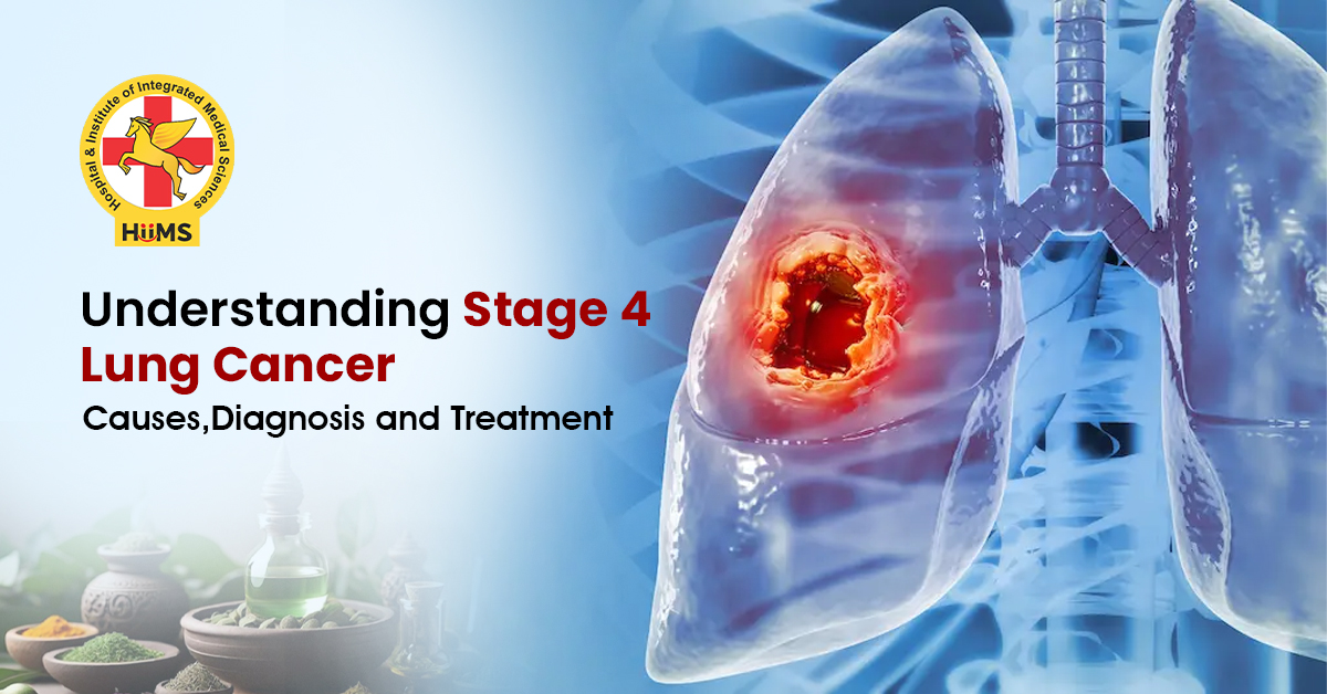 Stage-4-Lung-Cancer