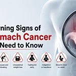7 Warning Signs of Stomach Cancer You Need to Know