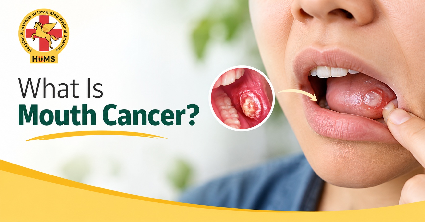 Mouth-Cancer