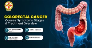 Colorectal Cancer