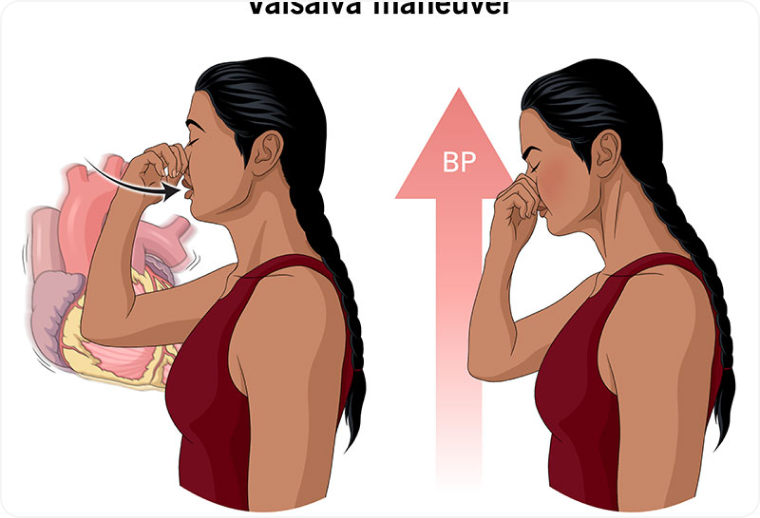 Valsalva Maneuver