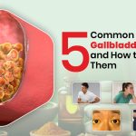 5 Common Signs of Gallbladder Stones and How to Manage Them