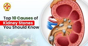 Top 10 Causes of Kidney Stones You Should Know
