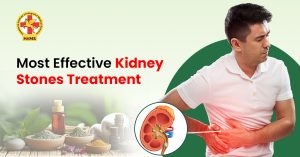 Most Effective Kidney Stones Treatment