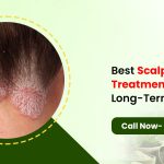 Best Scalp Psoriasis Treatment for Long-Term Relief