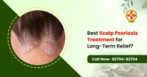 Best Scalp Psoriasis Treatment for Long-Term Relief