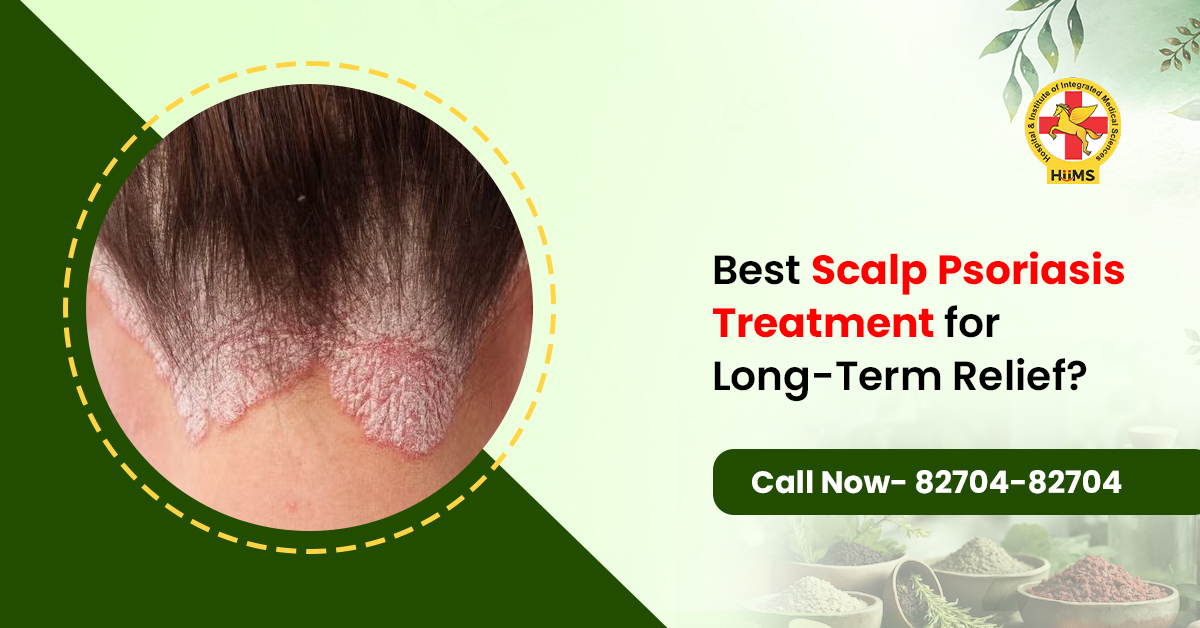 Best Scalp Psoriasis Treatment for Long-Term Relief