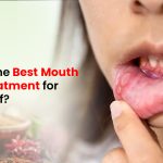 Best Mouth Ulcer Treatment for Fast Relief