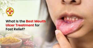 Best Mouth Ulcer Treatment for Fast Relief