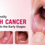 How to Identify Mouth Cancer Symptoms in the Early Stages?