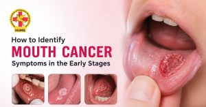 How-to-Identify-Mouth-Cancer-Symptoms-in-the-Early-Stages