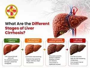 What-Are-the-Different-Stages-of-Liver-Cirrhosis