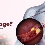 How to Know If You Have Heart Blockage? Signs and Diagnosis