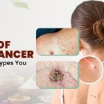 Types of Skin Cancer: 5 Common Types You Must Know