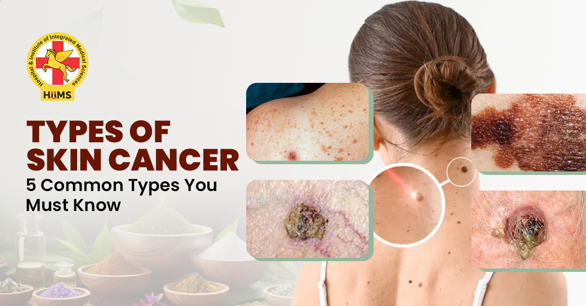 types of skin cancer
