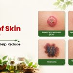 Types of Skin Cancer: Can Ayurveda Help Reduce Your Risk?