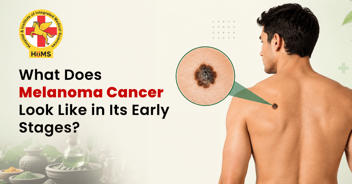 Melanoma Cancer in Its Early Stages