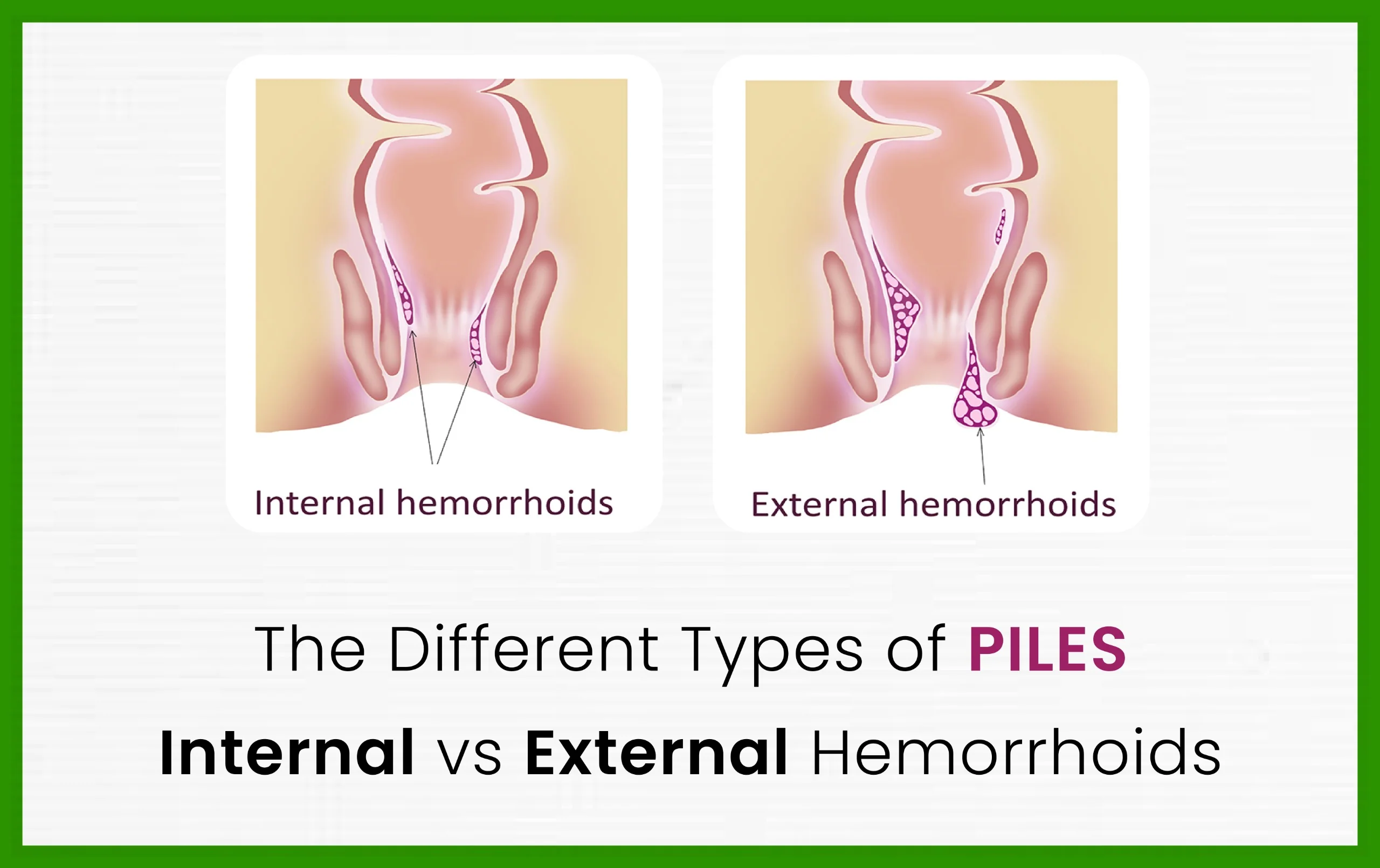 Difference Between Internal and External Hemorrhoids