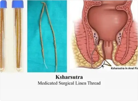 kshar sutra treatment