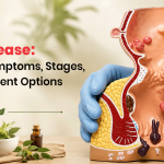 Piles Disease: Causes, Symptoms, Stages, and Treatment Options