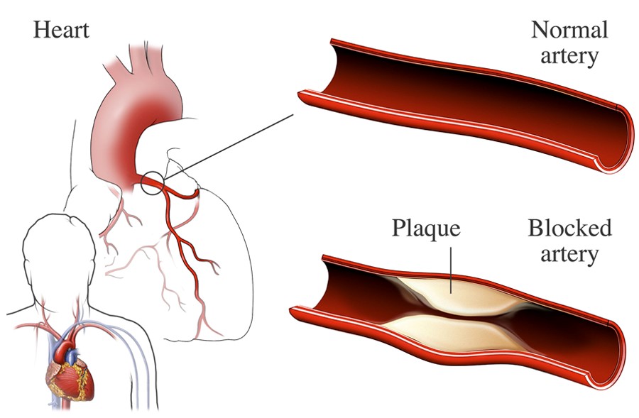 heart disease